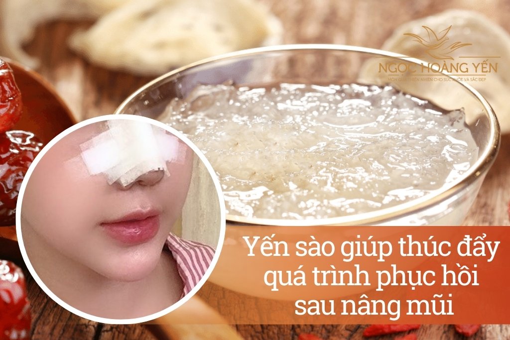 Yến sào giúp thúc đẩy quá trình phục hồi sau nâng mũi