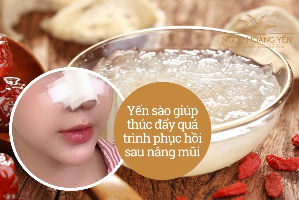 Yến sào giúp thúc đẩy quá trình phục hồi sau nâng mũi