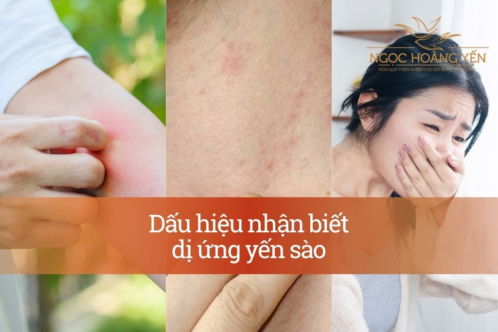 Dấu hiệu nhận biết dị ứng yến sào