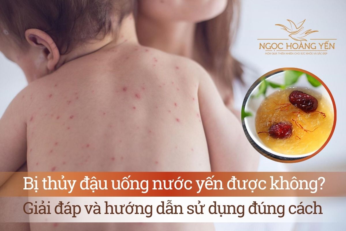 Bị thủy đậu uống nước yến được không? Giải đáp và hướng dẫn sử dụng đúng cách