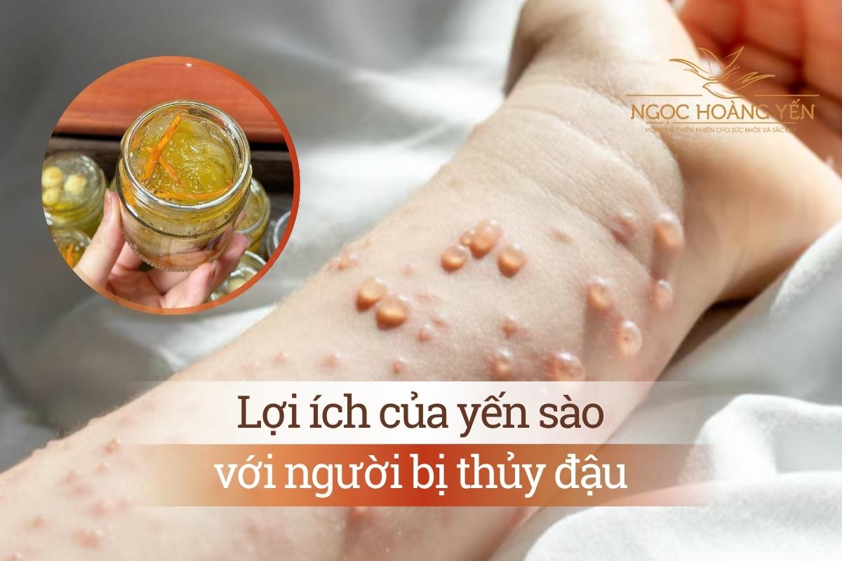 Lợi ích của yến sào với người bị thủy đậu
