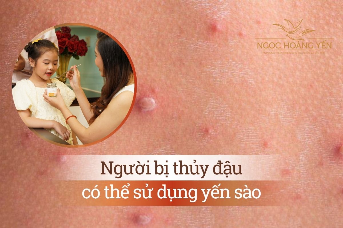 Người bị thủy đậu có thể sử dụng yến sào