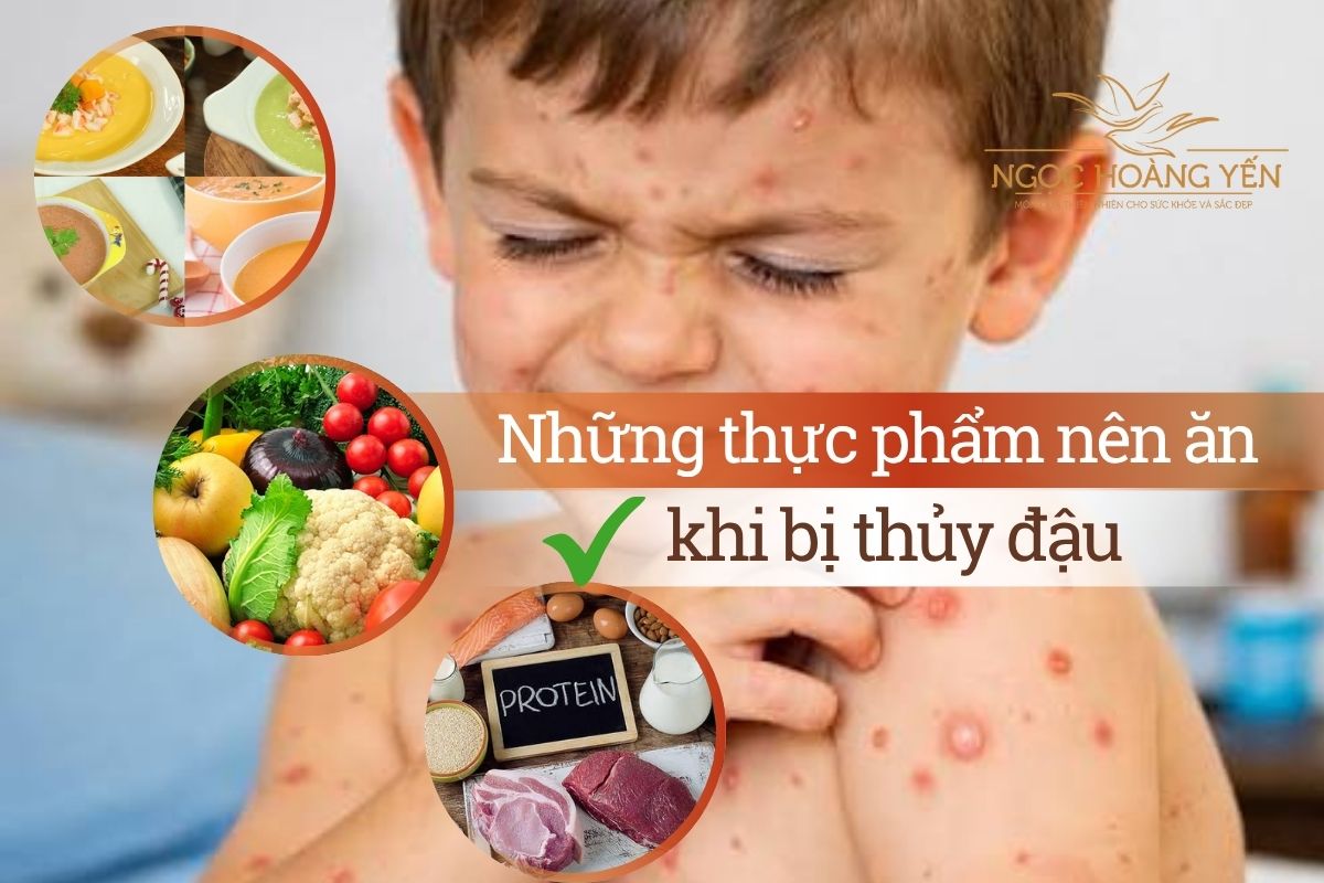 Những thực phẩm nên ăn khi bị thủy đậu