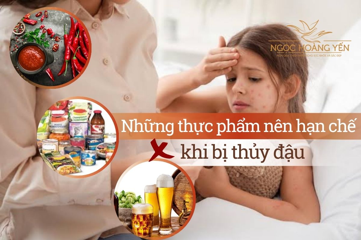 Những thực phẩm nên hạn chế ăn khi bị thủy đậu